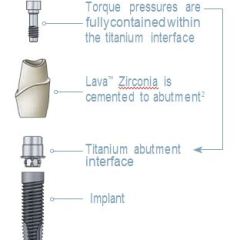 Zirconia Hybrid Dental Implant Abutments . . . The Best of Two Worlds!